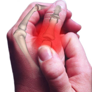 Quels sont les symptômes de l’arthrose ?